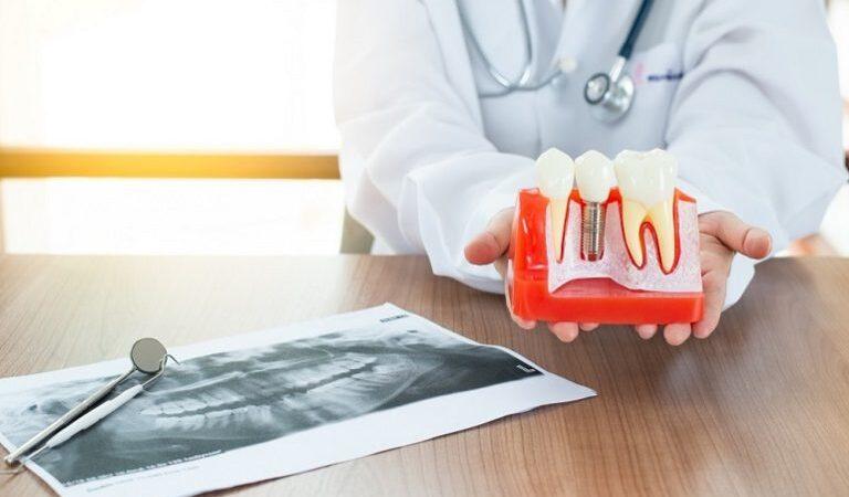 What Are Dental Implants and Its Advantages?